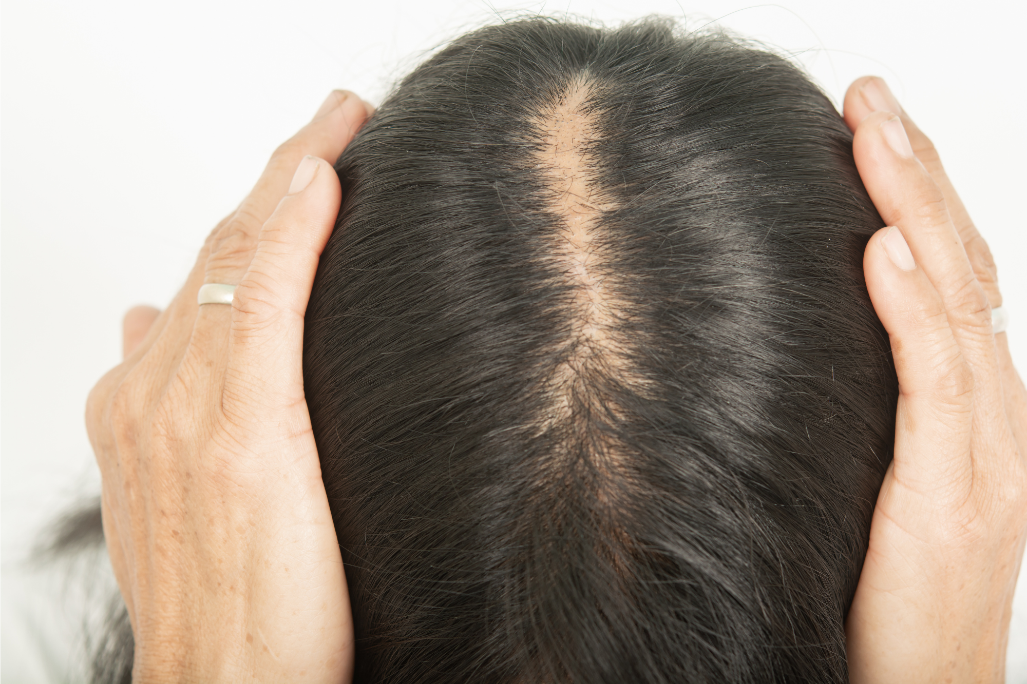 Supersonic hastighed Centralisere erstatte Can Thinning Hair Grow Back? Really? – Revela