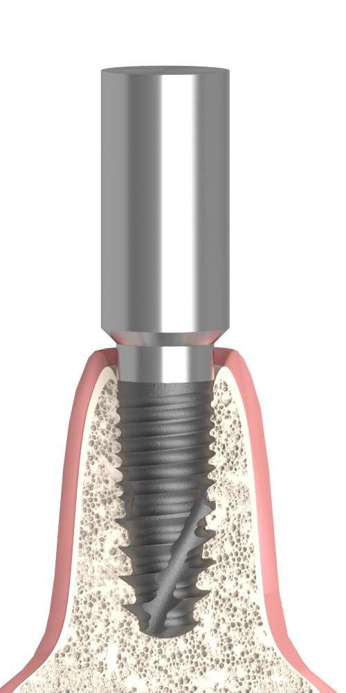 XiVE® Friadent® (FR) Compatible Scanbody becsavarható, nem pozicionált
