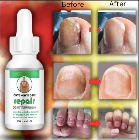 Nail Serum For Complete Nail Protection, Long healthy & fungus free nails