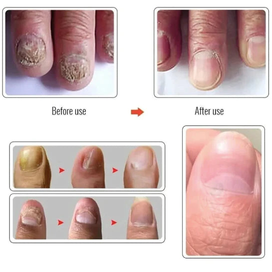 Nail Serum For Complete Nail Protection, Long healthy & fungus free nails