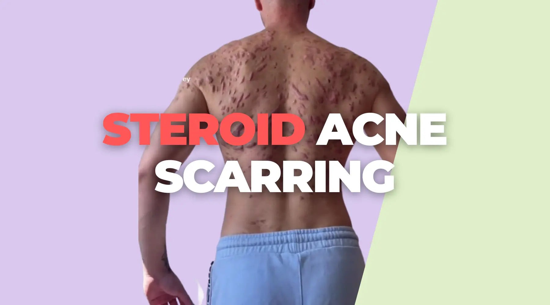 How To Prevent Acne Scarring From Anabolic Steroids Aqneeq