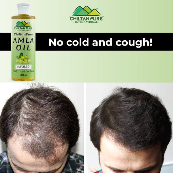 Amla Oil – Lessen Hair Loss, Boosts Hair Growth, Treats Dry Scalp & Pr –  ChiltanPure