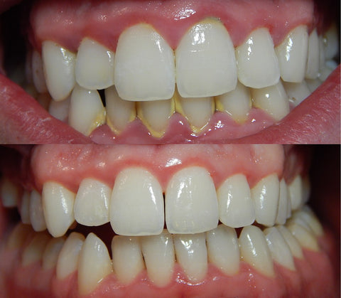 gum disease starts with plaque around the teeth