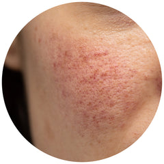 A woman's cheek during a rosacea flare-up