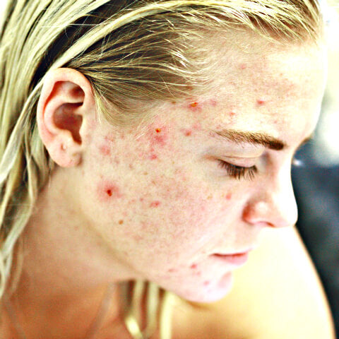 Girl with bad acne on her face