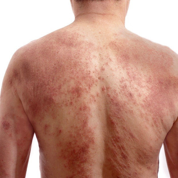 What is red skin syndrome? – Eczema Life