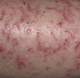 eczema