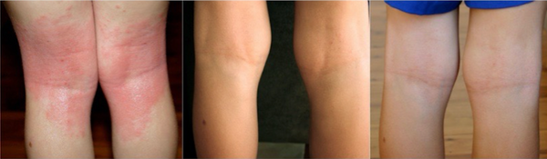 Ayva before and after Skin Friend eczema treatment