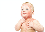 baby with eczema image