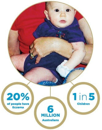 Eczema statistics - photo of Ayva