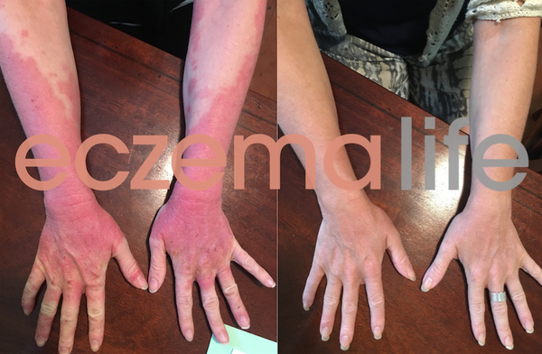 Eczema before and after Skin Friend The Eczema Detox