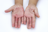 contact dermatitis