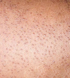 Keratosis pilaris