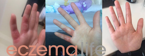 Eczema diet before and after