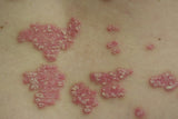 psoriasis