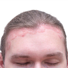 Seborrheic dermatitis image