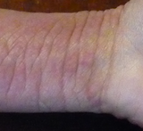 topical steroid withdrawal