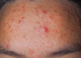 acne image