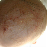 cradle cap image