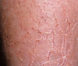 Asteatotic eczema