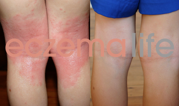 Eczema photos and treatment info