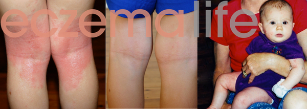 Eczema detox before and after Karen Fischer
