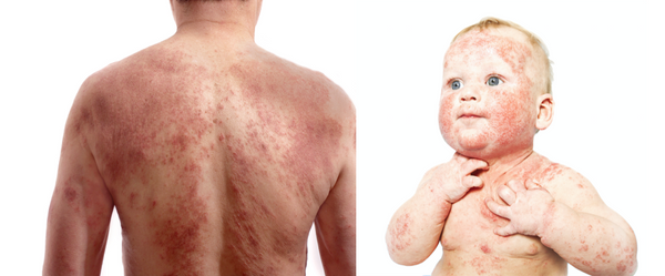Eczema images atopic dermatitis