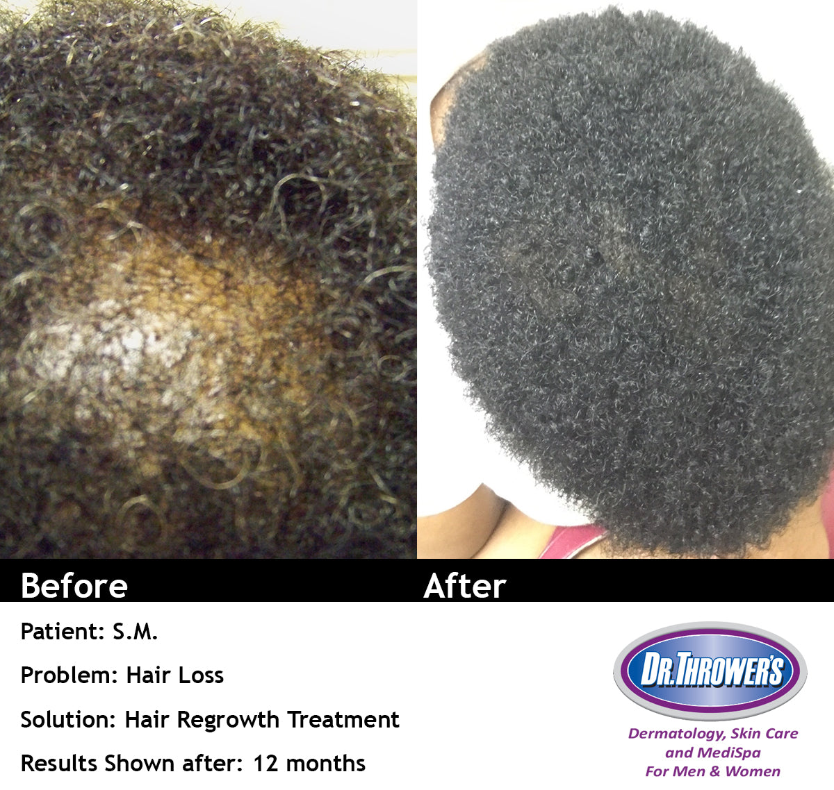 Dr. Thrower's Skin Care Thro-Grower with Minoxidil 5% Hair Regrowth Before & After