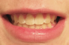 braces off teeth white spots