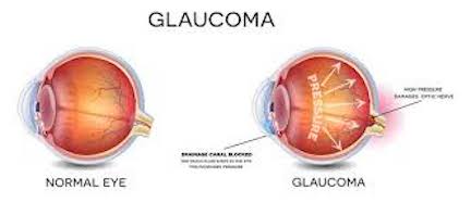 Glaucoma Image