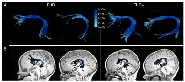 Altered reading network connectivity of infants at risk for reading disability