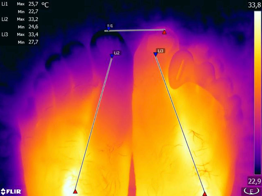 Another infrared image showing the effect of Correct Toes toe spacers on foot and toe circulation
