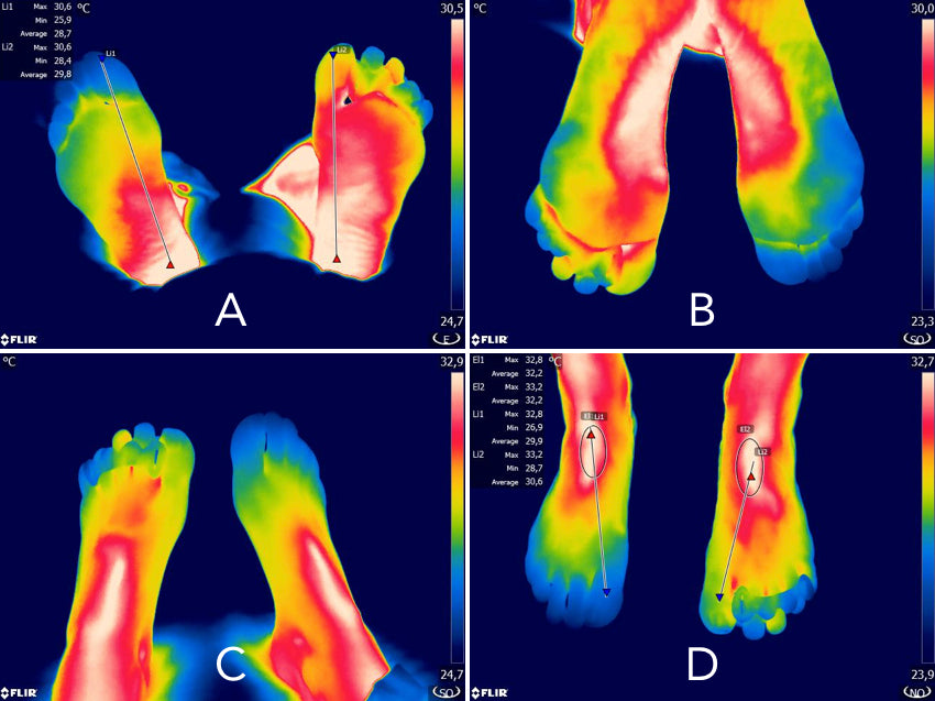 A collection of four images showing Correct Toes' impact on foot and toe blood flow