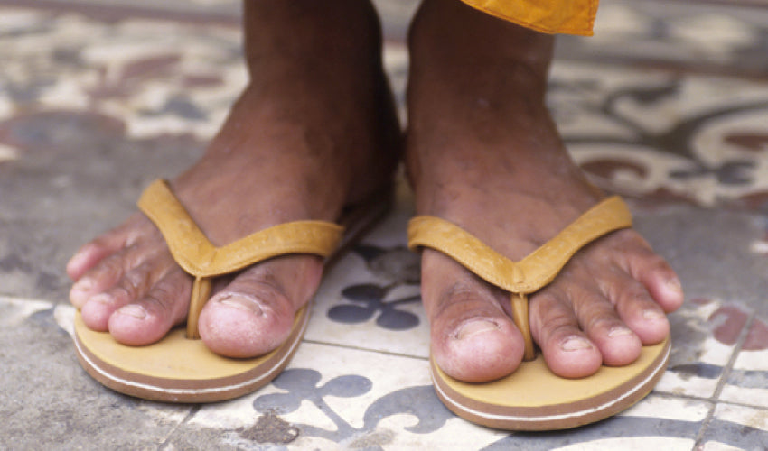 Healthy, splayed-toe feet wearing orange flip-flops