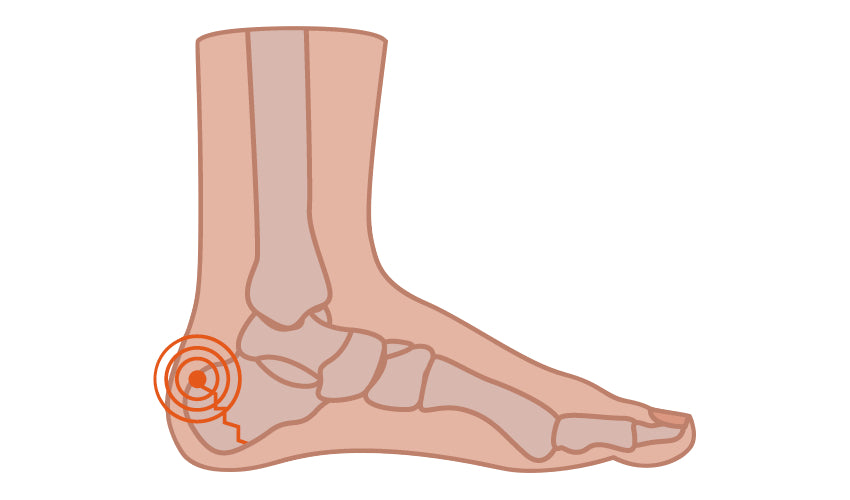 Sever's Disease | Natural Footgear