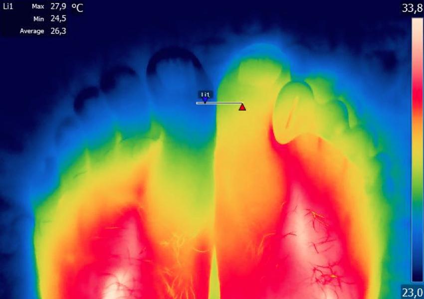 An infrared image showing the heat differential between a foot wearing Correct Toes and one that is not wearing Correct Toes