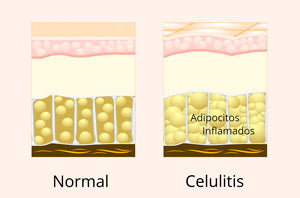 Entender la celulitis y como reducir la celulitis