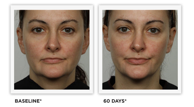 Clinically Tested - images - Improved Tone, Defined Facial Contour, Lifted Corner of Mouth