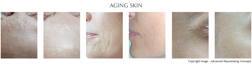 Aging Skin, Enlarged Pores, Rough Texture Clinical Evaluation Ultrasonic