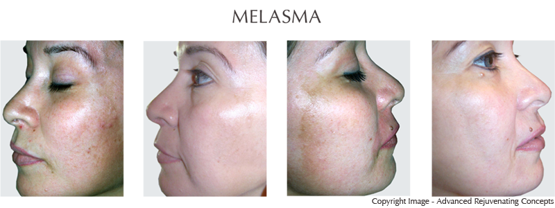 Melasma Discolorations Clinical Evaluation of Lightening Products