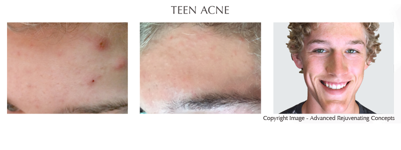 Teen Acne Clinical Evaluation with Salicylic Acid and Blemish Control
