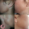 No Grow Female Facial Hair Remover Results