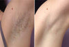 Female underarm before and after images using No Grow