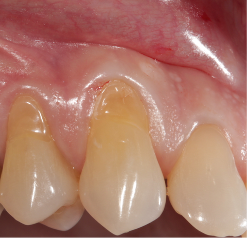 How to slove tooth abrasion and clean teeth properly.