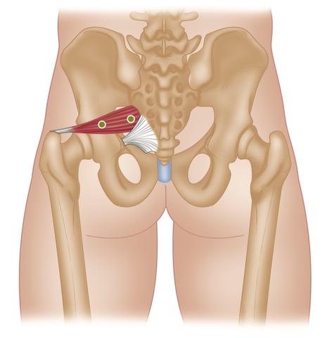 Piriformis Trigger Points Sciatica