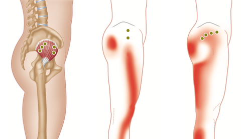 Gluteus Minimus Trigger Points