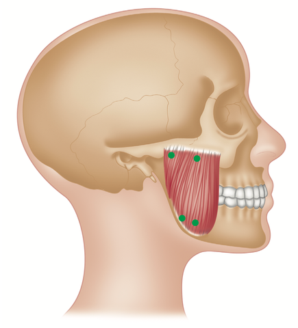 Masseter Trigger Points 