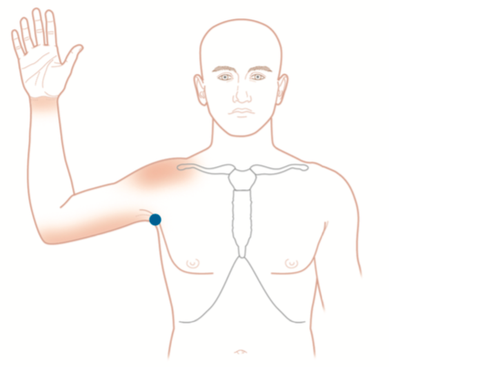 Subscapularis Trigger Point Pain Map