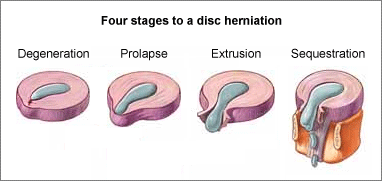 Stages of Disc Herniation