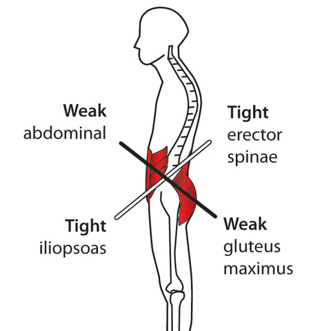 Trigger Point Therapy - Lower Crossed Pattern